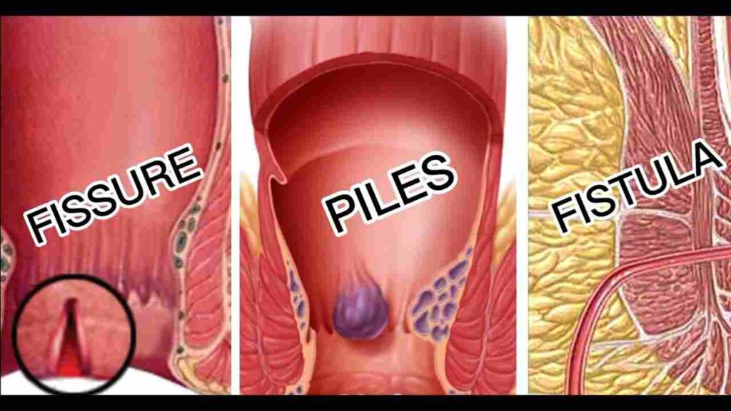 Difference between Piles and Fissure poster